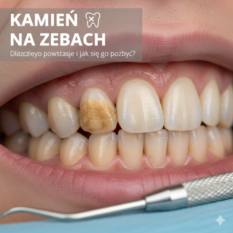 Kamień na zębach